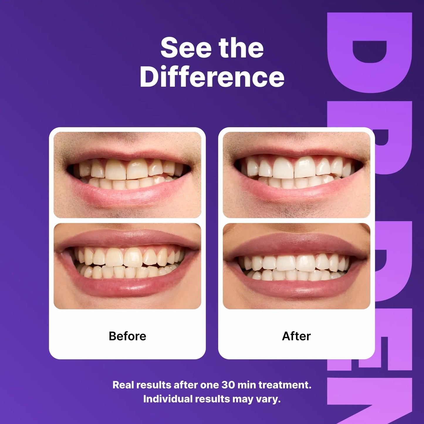 ✨ Teeth Whitening Strips | Peroxide-Free & Gentle Formula